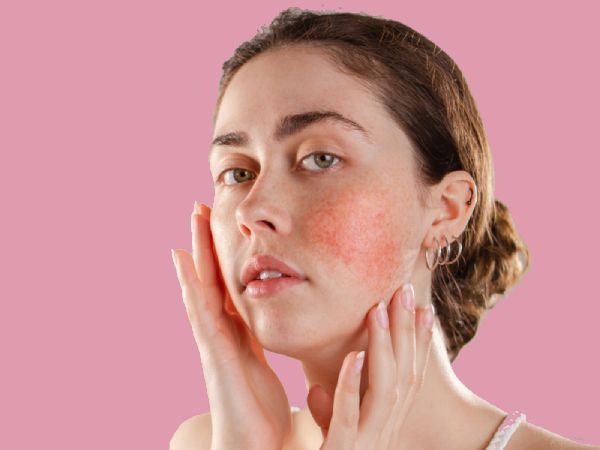 How to Relieve Rosacea Naturally