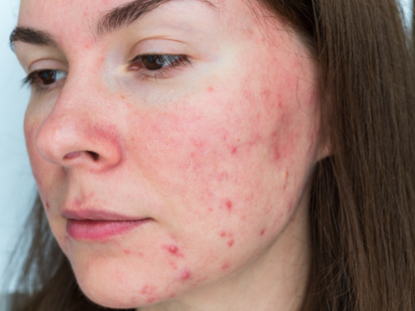 Skincare Products for Rosacea